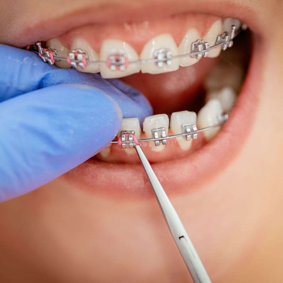 Fiksni aparatić za djecu