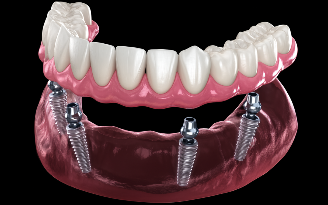 All-on-4 – Eine moderne Lösung bei vollständigem Zahnverlust