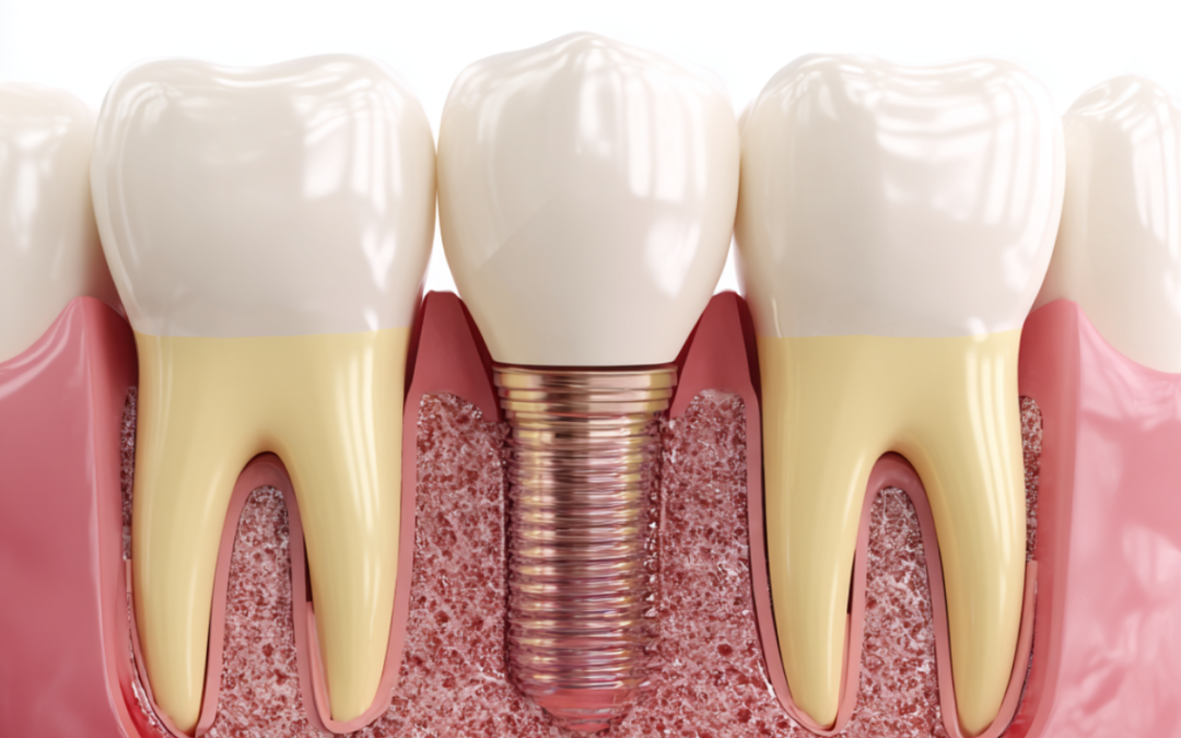 “Zubi na šarafe” – Razbijamo mitove o bolu i oporavku