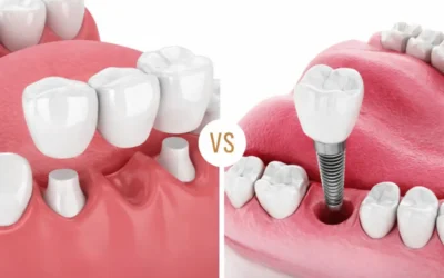 Zubni most ili Implantat: Kako donijeti pravu odluku?