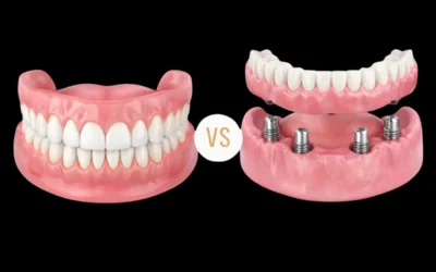 Zubna proteza na klik vs. klasična proteza – Zašto preći na implante?