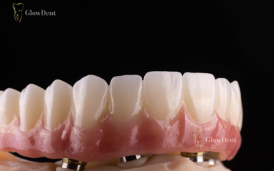 All on X implantati u Banja Luci – Kompletan vodič | GlowDent