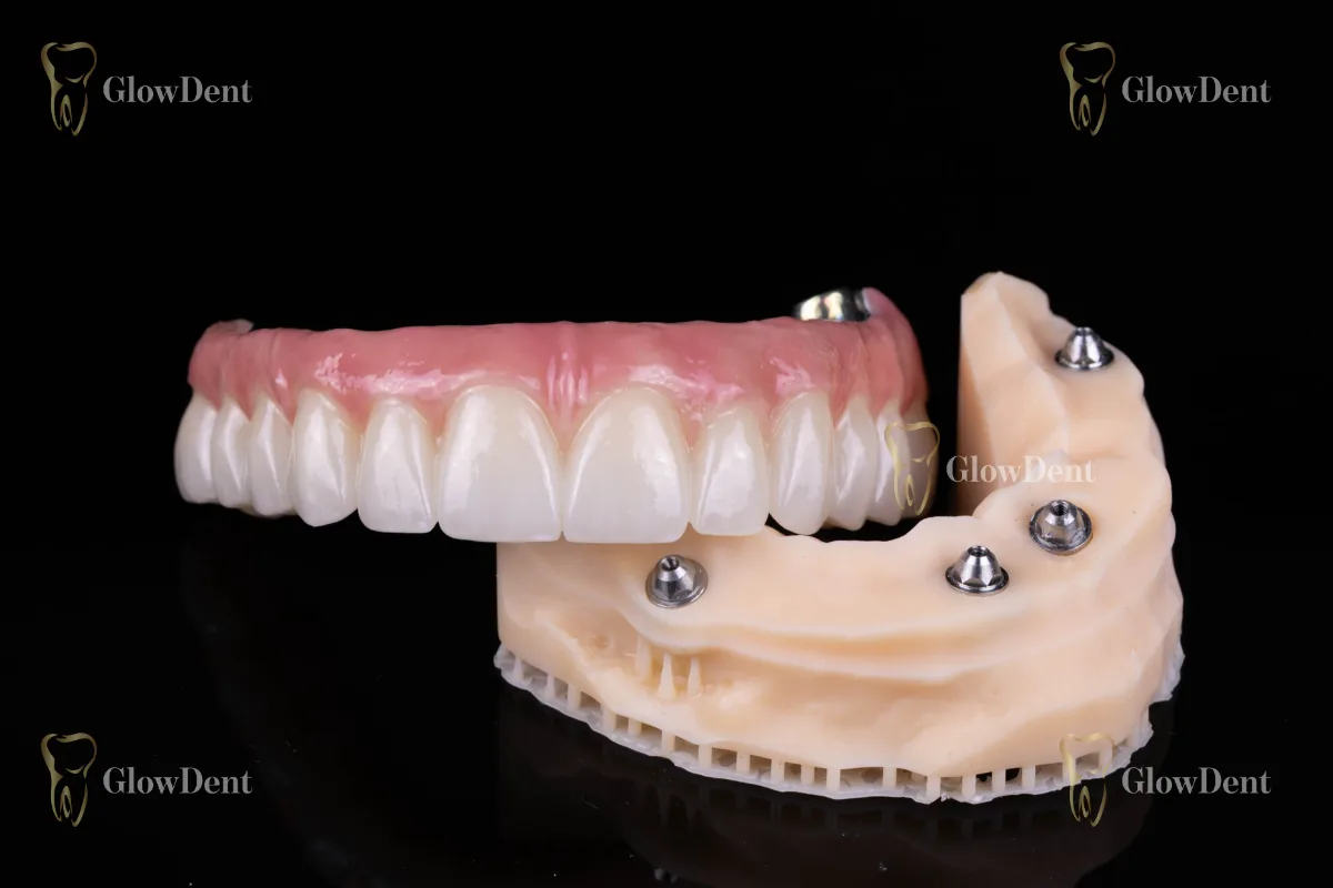 All-on-4 protetski rad na implantatima – GlowDent Banja Luka